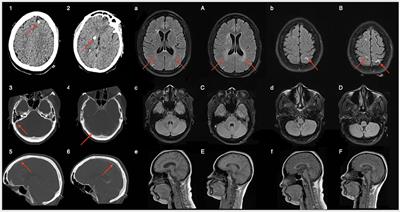 CSF HIV RNA Escape in Opsoclonus-Myoclonus-Ataxia Syndrome: Case Report and Review of the Literature